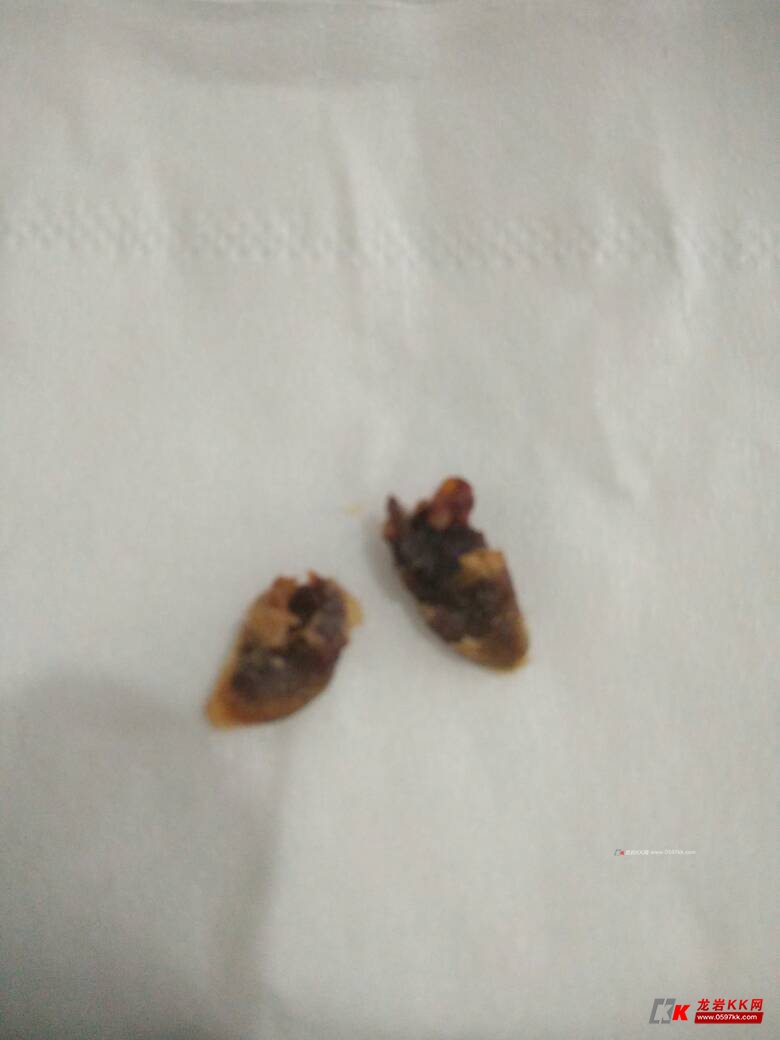 今天一8岁小男孩,两只耳朵都掏出来又黑又大耳结石,假期你们带孩子来